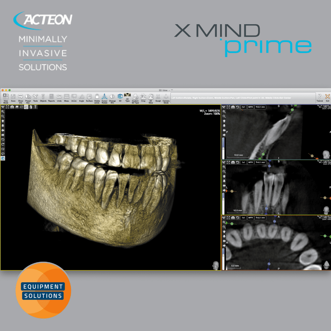Acteon Prime 2D and 3D CBCT Dental Imaging System offers the easy to use AIS software