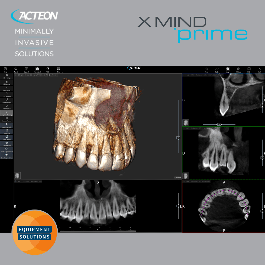 Acteon Prime 2D and 3D CBCT Dental Imaging System offers the easy to use AIS software