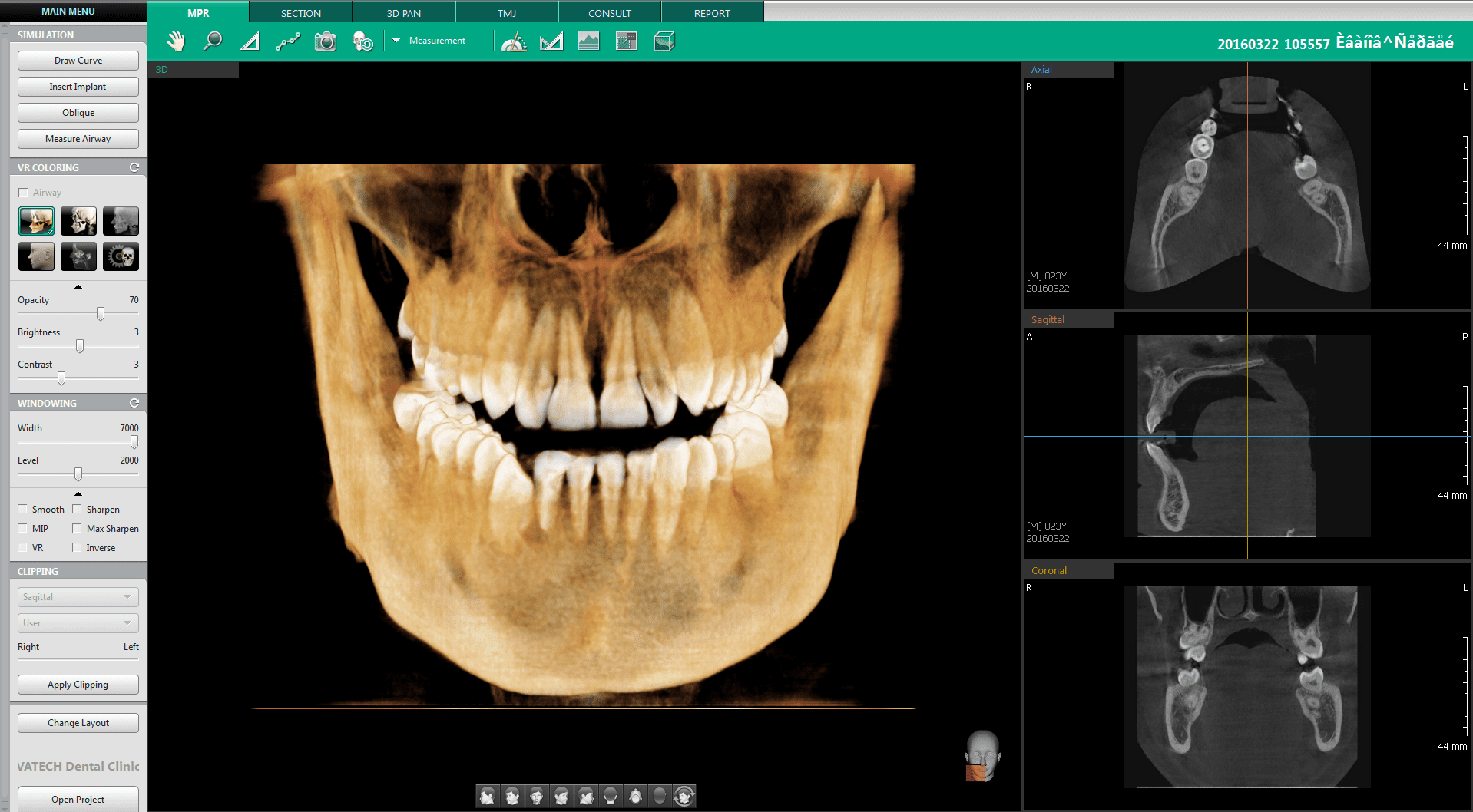 Ez3D-i_01 software for Vatech's Digital Equipment Range